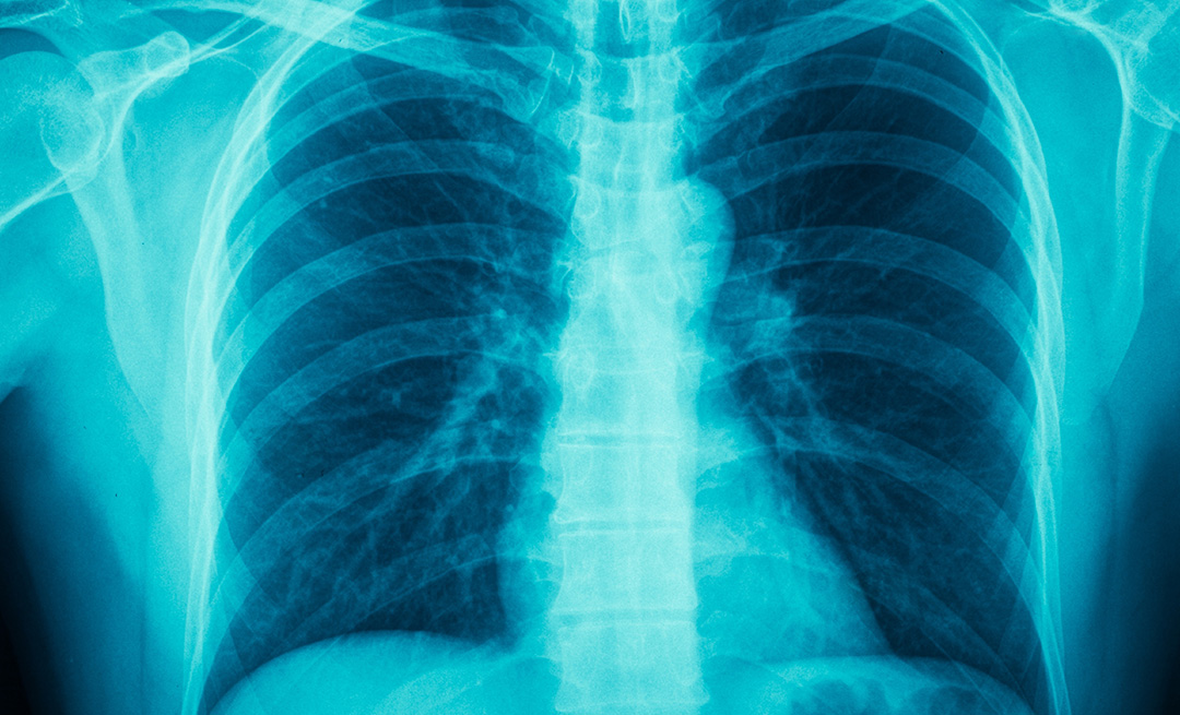 an x-ray of a chest